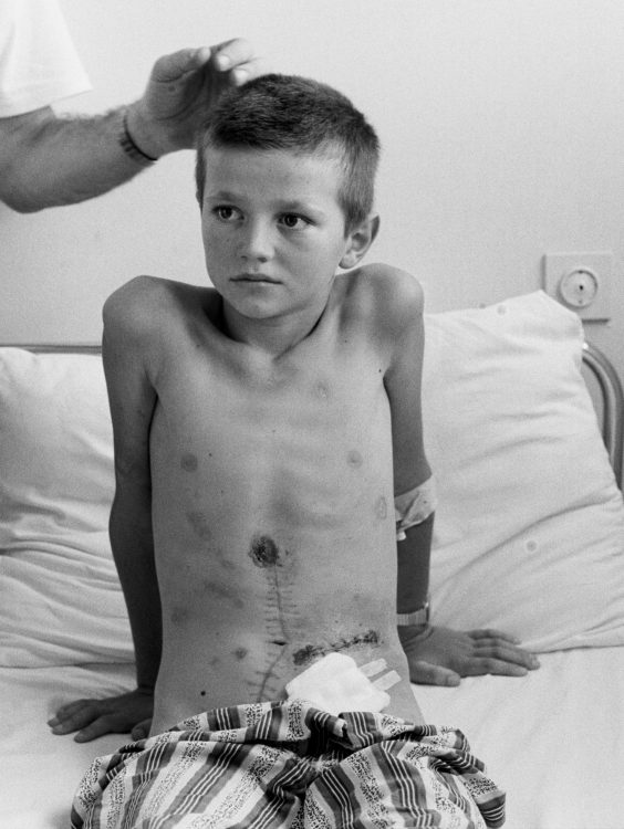 Ivan Miilos, 9, is examined in a hospital in Mostar. He was hit by shrapnel while lying in his bed.