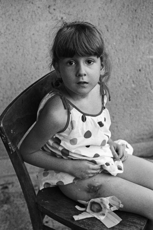 5 year old Olja Radulovic almost bled to death after she was hit in the back and legs by shrapnel from a mortar shell as she and her sister played in her garden during a Serbian “cease fire.”
